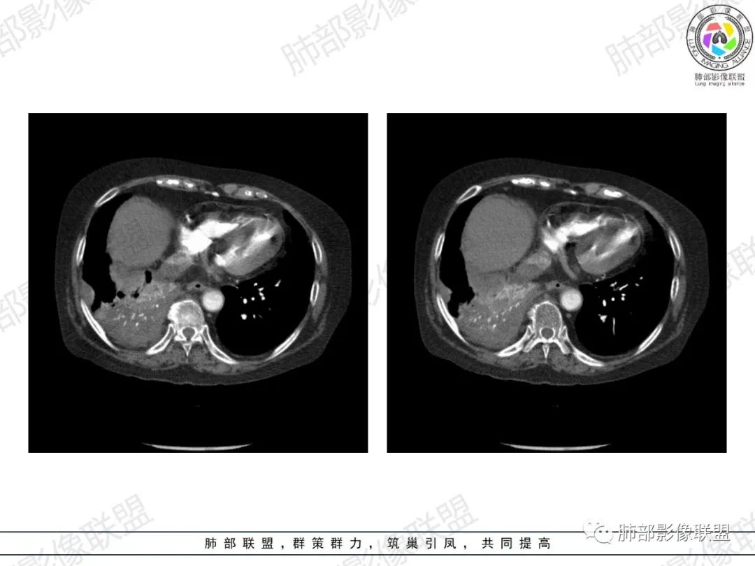 影像PPT - 【病例】肺部弥漫大B细胞淋巴瘤1例CT影像讨论-47 影像PPT - 【病例】肺部弥漫大B细胞淋巴瘤1例CT影像讨论-47
