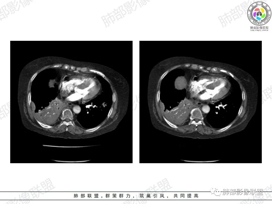 影像PPT - 【病例】肺部弥漫大B细胞淋巴瘤1例CT影像讨论-45 影像PPT - 【病例】肺部弥漫大B细胞淋巴瘤1例CT影像讨论-45