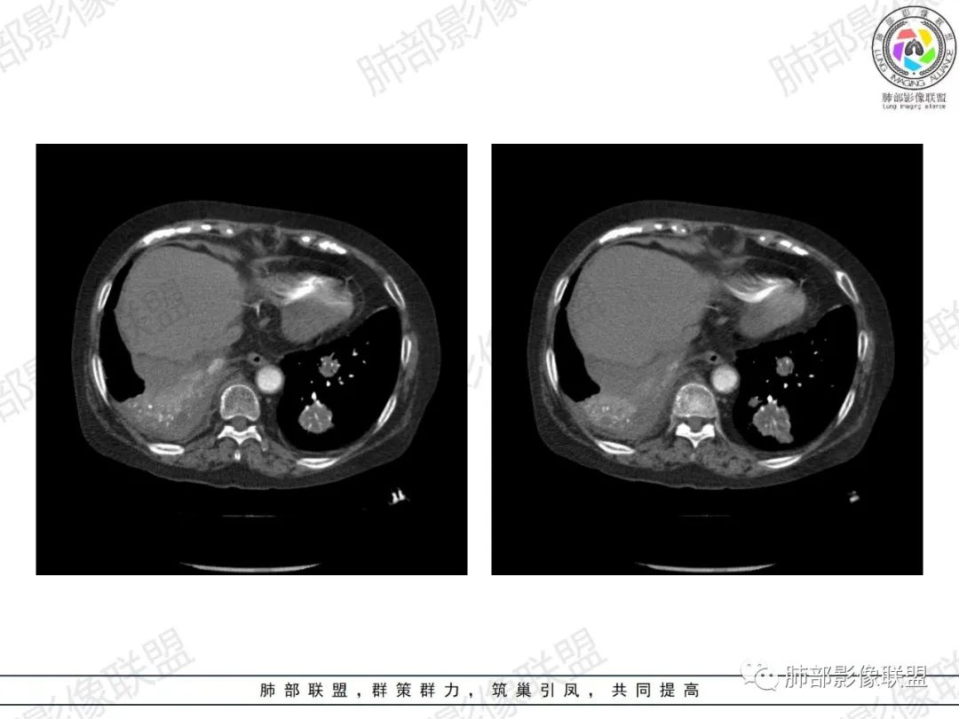 影像PPT - 【病例】肺部弥漫大B细胞淋巴瘤1例CT影像讨论-49 影像PPT - 【病例】肺部弥漫大B细胞淋巴瘤1例CT影像讨论-49
