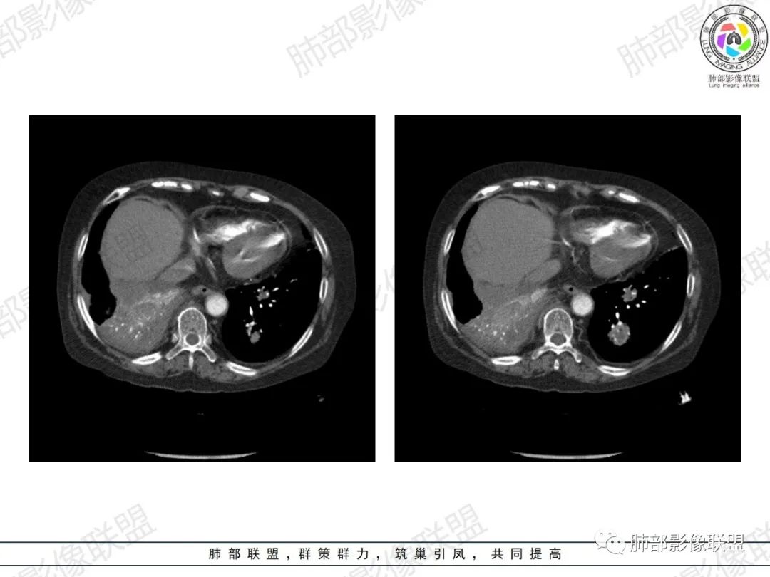 影像PPT - 【病例】肺部弥漫大B细胞淋巴瘤1例CT影像讨论-48 影像PPT - 【病例】肺部弥漫大B细胞淋巴瘤1例CT影像讨论-48