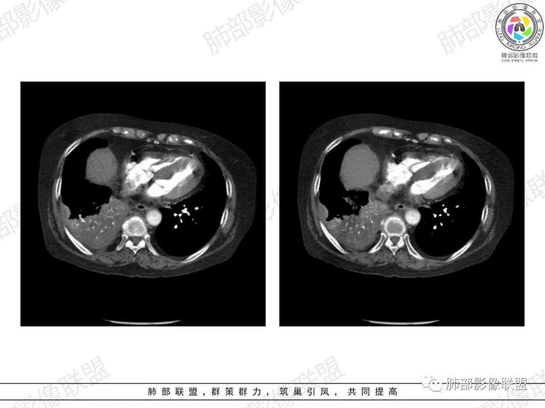 影像PPT - 【病例】肺部弥漫大B细胞淋巴瘤1例CT影像讨论-46 影像PPT - 【病例】肺部弥漫大B细胞淋巴瘤1例CT影像讨论-46