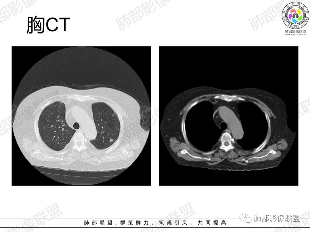 影像PPT - 【病例】肺部弥漫大B细胞淋巴瘤1例CT影像讨论-4 影像PPT - 【病例】肺部弥漫大B细胞淋巴瘤1例CT影像讨论-4