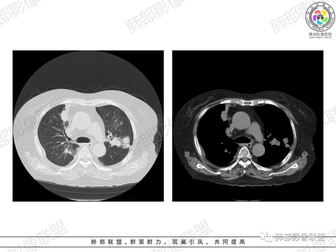 影像PPT - 【病例】肺部弥漫大B细胞淋巴瘤1例CT影像讨论-9 影像PPT - 【病例】肺部弥漫大B细胞淋巴瘤1例CT影像讨论-9