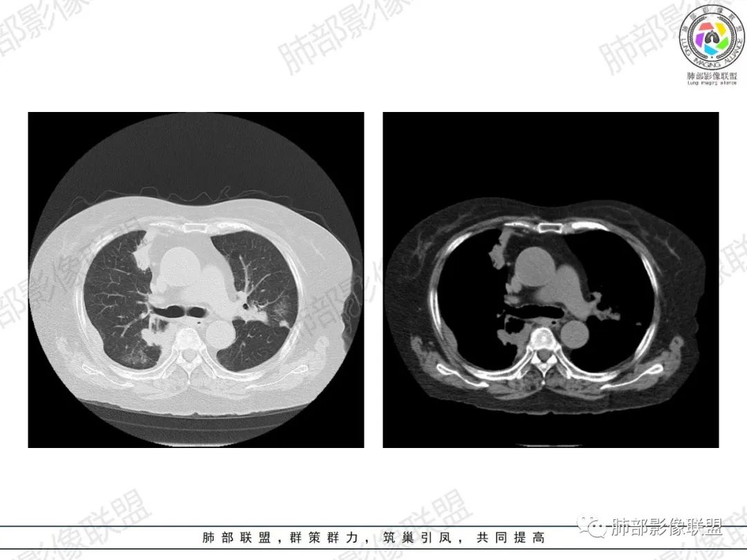 影像PPT - 【病例】肺部弥漫大B细胞淋巴瘤1例CT影像讨论-10 影像PPT - 【病例】肺部弥漫大B细胞淋巴瘤1例CT影像讨论-10