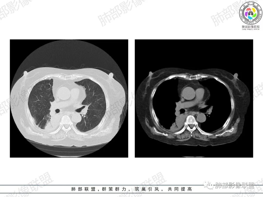 影像PPT - 【病例】肺部弥漫大B细胞淋巴瘤1例CT影像讨论-14 影像PPT - 【病例】肺部弥漫大B细胞淋巴瘤1例CT影像讨论-14