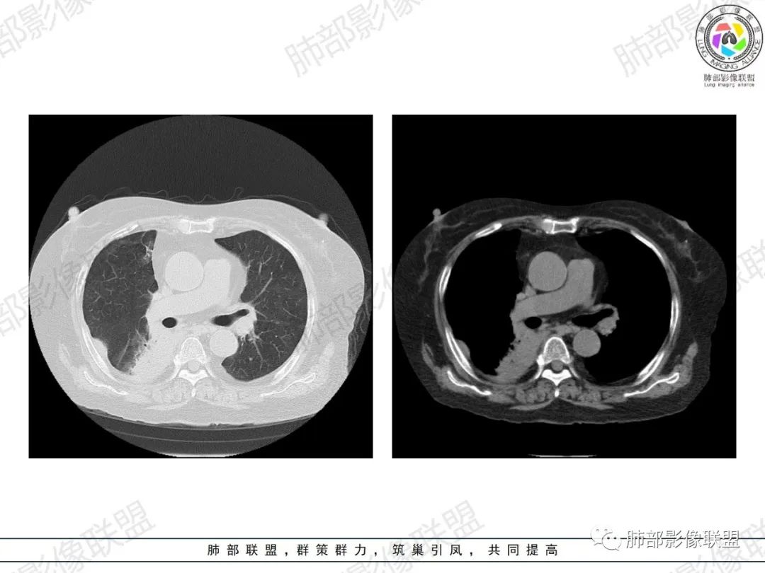 影像PPT - 【病例】肺部弥漫大B细胞淋巴瘤1例CT影像讨论-13 影像PPT - 【病例】肺部弥漫大B细胞淋巴瘤1例CT影像讨论-13