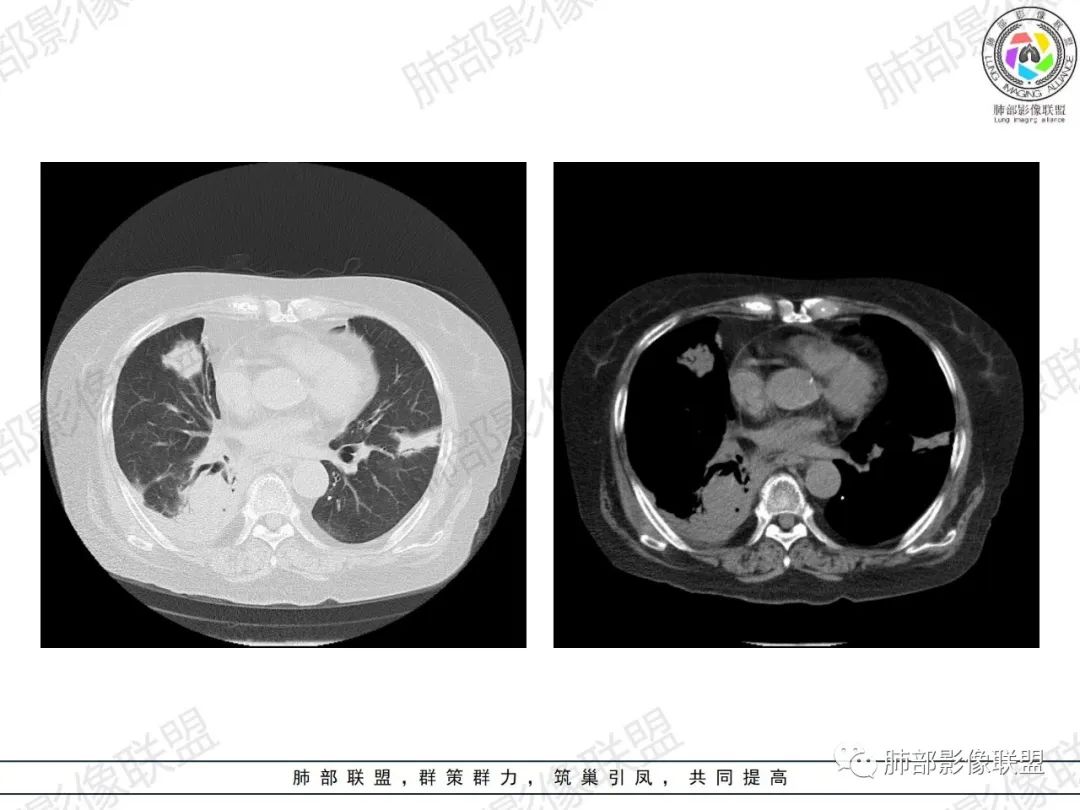 影像PPT - 【病例】肺部弥漫大B细胞淋巴瘤1例CT影像讨论-18 影像PPT - 【病例】肺部弥漫大B细胞淋巴瘤1例CT影像讨论-18