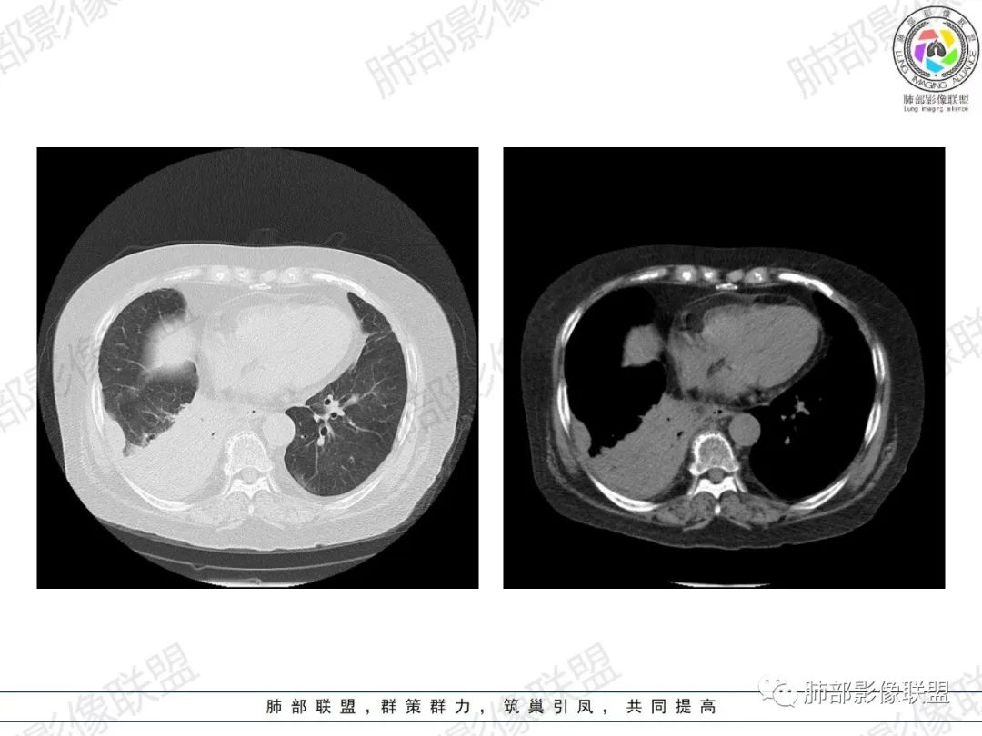 影像PPT - 【病例】肺部弥漫大B细胞淋巴瘤1例CT影像讨论-22 影像PPT - 【病例】肺部弥漫大B细胞淋巴瘤1例CT影像讨论-22