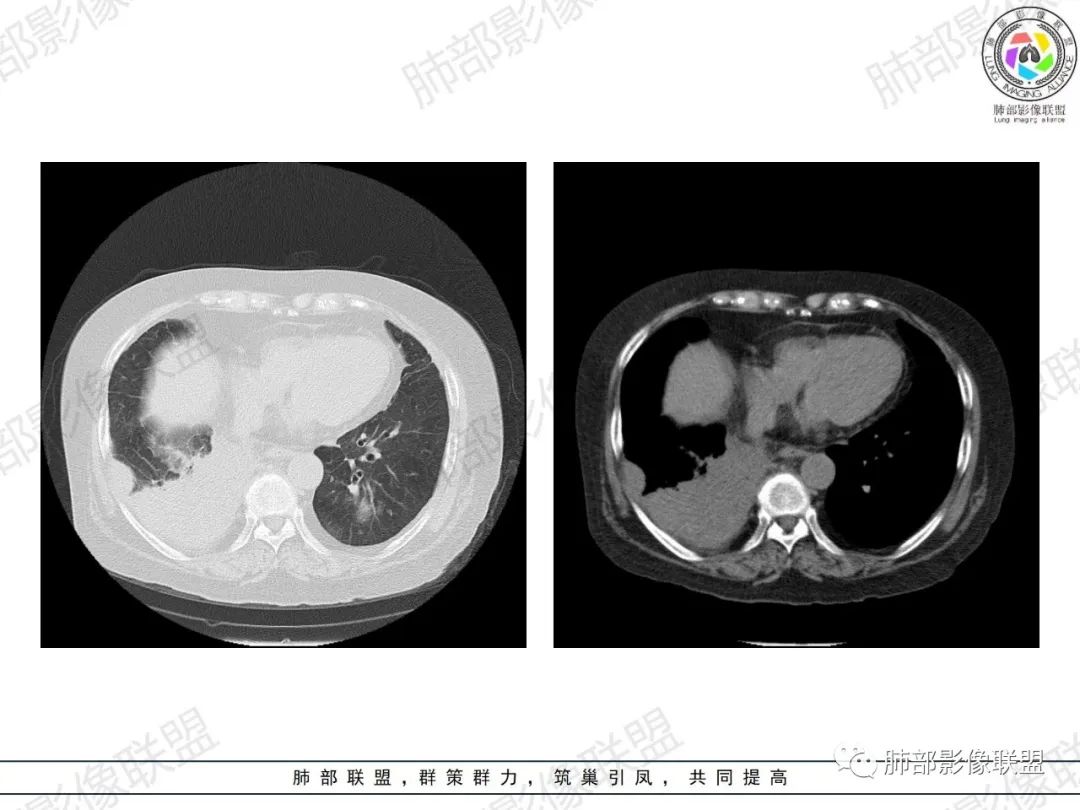 影像PPT - 【病例】肺部弥漫大B细胞淋巴瘤1例CT影像讨论-23 影像PPT - 【病例】肺部弥漫大B细胞淋巴瘤1例CT影像讨论-23