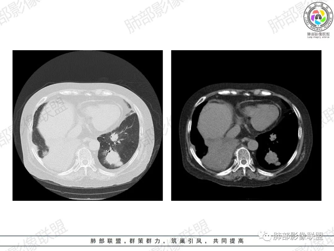 影像PPT - 【病例】肺部弥漫大B细胞淋巴瘤1例CT影像讨论-25 影像PPT - 【病例】肺部弥漫大B细胞淋巴瘤1例CT影像讨论-25