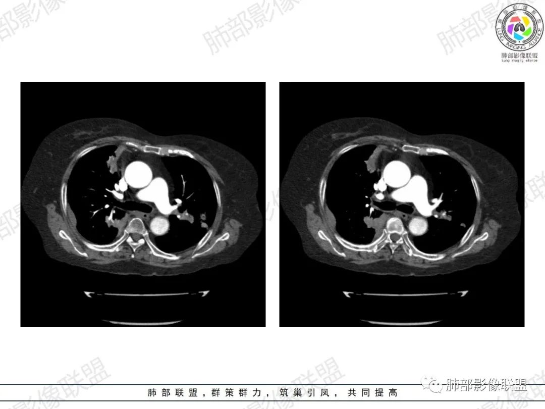 影像PPT - 【病例】肺部弥漫大B细胞淋巴瘤1例CT影像讨论-35 影像PPT - 【病例】肺部弥漫大B细胞淋巴瘤1例CT影像讨论-35