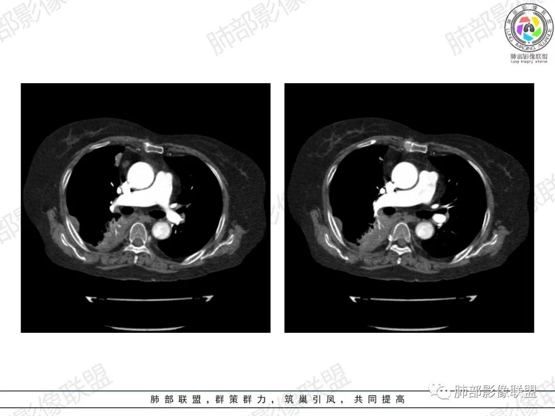 影像PPT - 【病例】肺部弥漫大B细胞淋巴瘤1例CT影像讨论-37 影像PPT - 【病例】肺部弥漫大B细胞淋巴瘤1例CT影像讨论-37