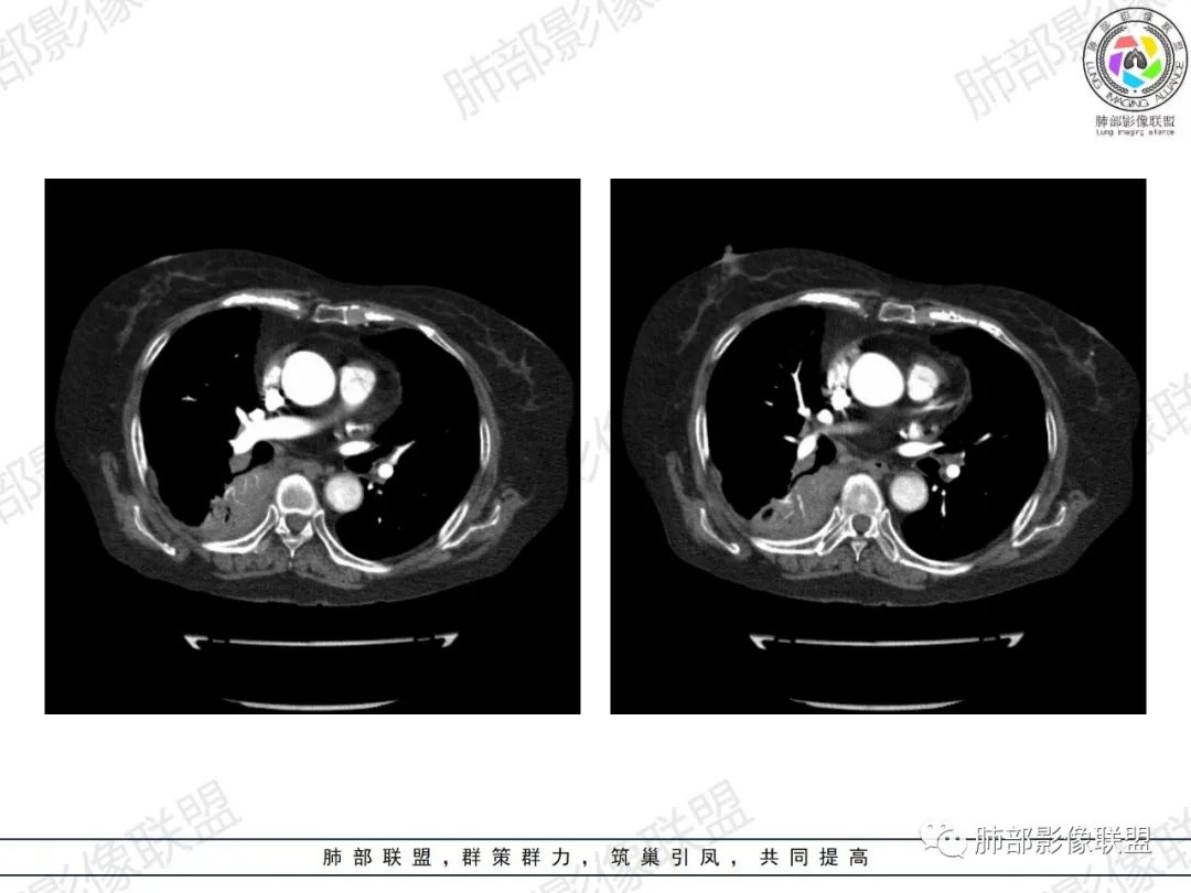 影像PPT - 【病例】肺部弥漫大B细胞淋巴瘤1例CT影像讨论-39 影像PPT - 【病例】肺部弥漫大B细胞淋巴瘤1例CT影像讨论-39
