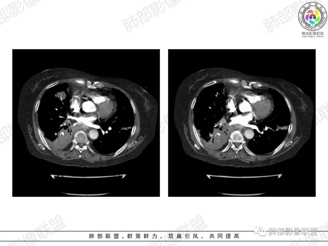 影像PPT - 【病例】肺部弥漫大B细胞淋巴瘤1例CT影像讨论-42 影像PPT - 【病例】肺部弥漫大B细胞淋巴瘤1例CT影像讨论-42