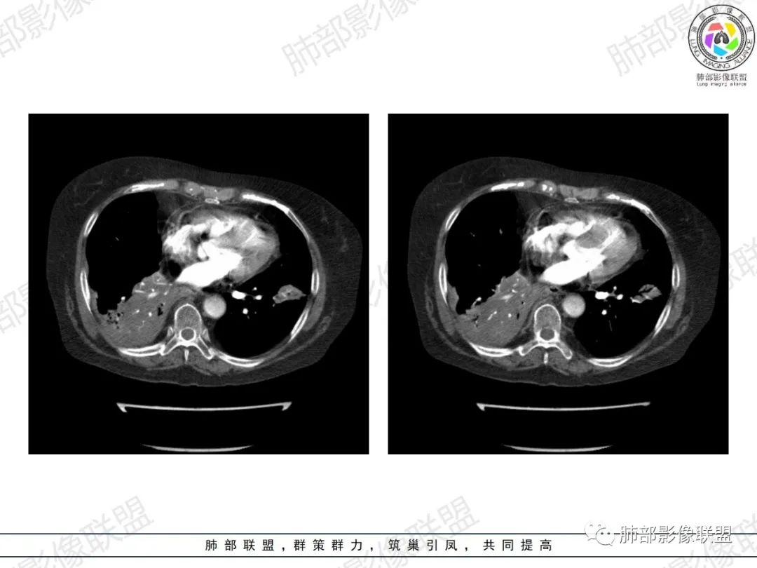 影像PPT - 【病例】肺部弥漫大B细胞淋巴瘤1例CT影像讨论-44 影像PPT - 【病例】肺部弥漫大B细胞淋巴瘤1例CT影像讨论-44