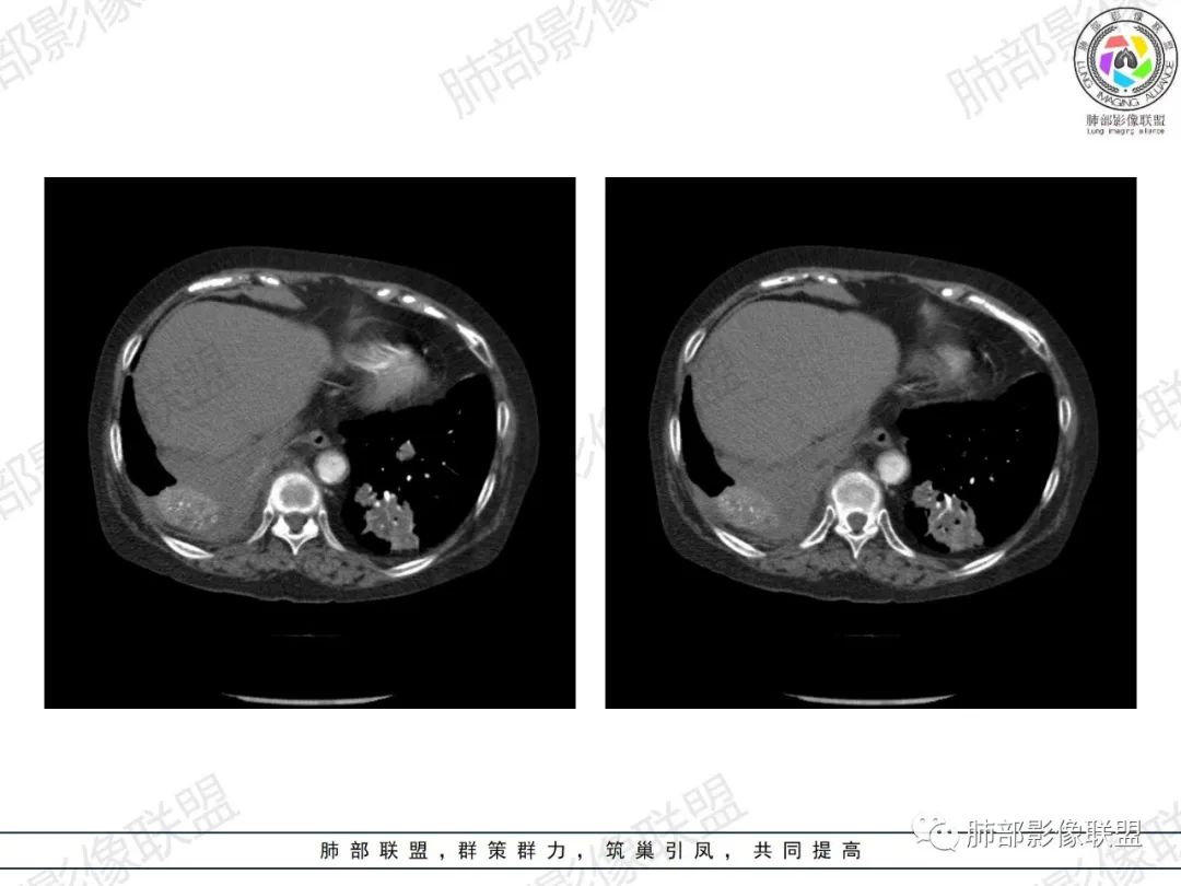 影像PPT - 【病例】肺部弥漫大B细胞淋巴瘤1例CT影像讨论-50 影像PPT - 【病例】肺部弥漫大B细胞淋巴瘤1例CT影像讨论-50