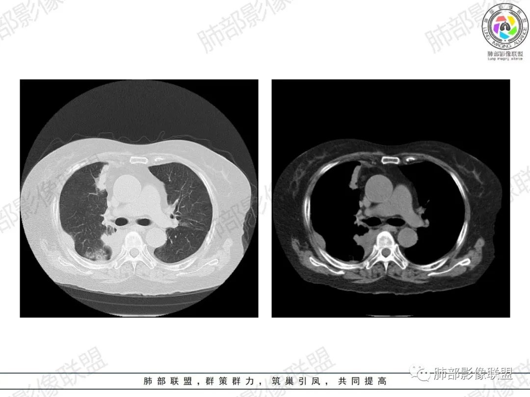 影像PPT - 【病例】肺部弥漫大B细胞淋巴瘤1例CT影像讨论-2 影像PPT - 【病例】肺部弥漫大B细胞淋巴瘤1例CT影像讨论-2