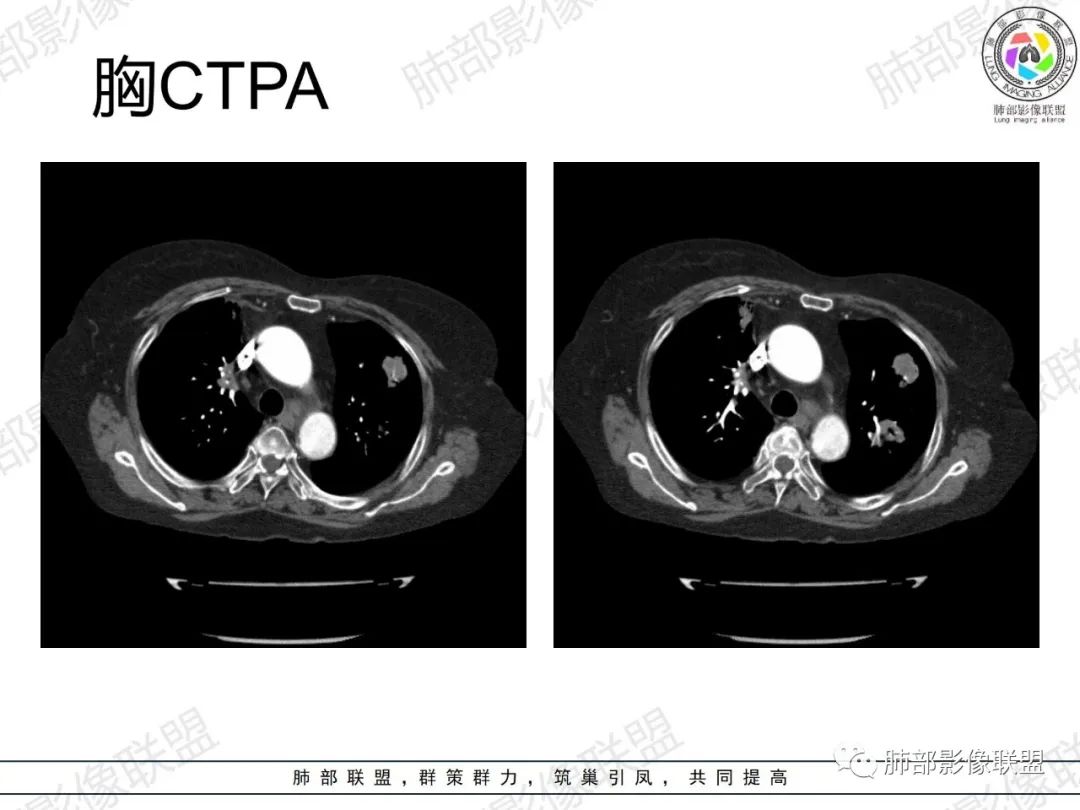 影像PPT - 【病例】肺部弥漫大B细胞淋巴瘤1例CT影像讨论-3 影像PPT - 【病例】肺部弥漫大B细胞淋巴瘤1例CT影像讨论-3