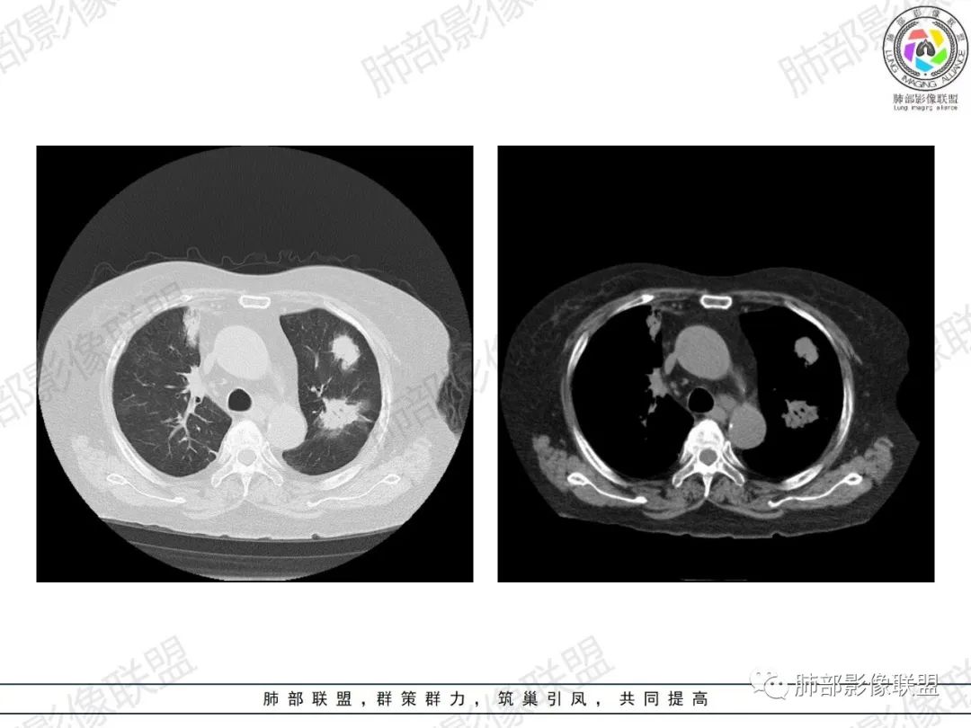 影像PPT - 【病例】肺部弥漫大B细胞淋巴瘤1例CT影像讨论-1 影像PPT - 【病例】肺部弥漫大B细胞淋巴瘤1例CT影像讨论-1