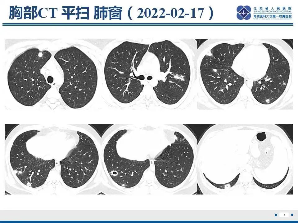 影像PPT - 【PPT】坏死梭杆菌肺炎-5
