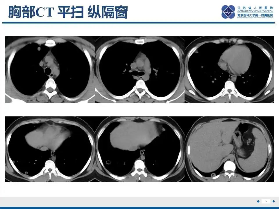 影像PPT - 【PPT】坏死梭杆菌肺炎-6