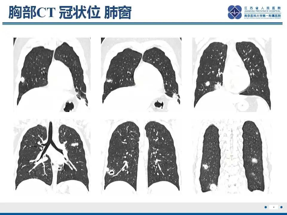 影像PPT - 【PPT】坏死梭杆菌肺炎-7