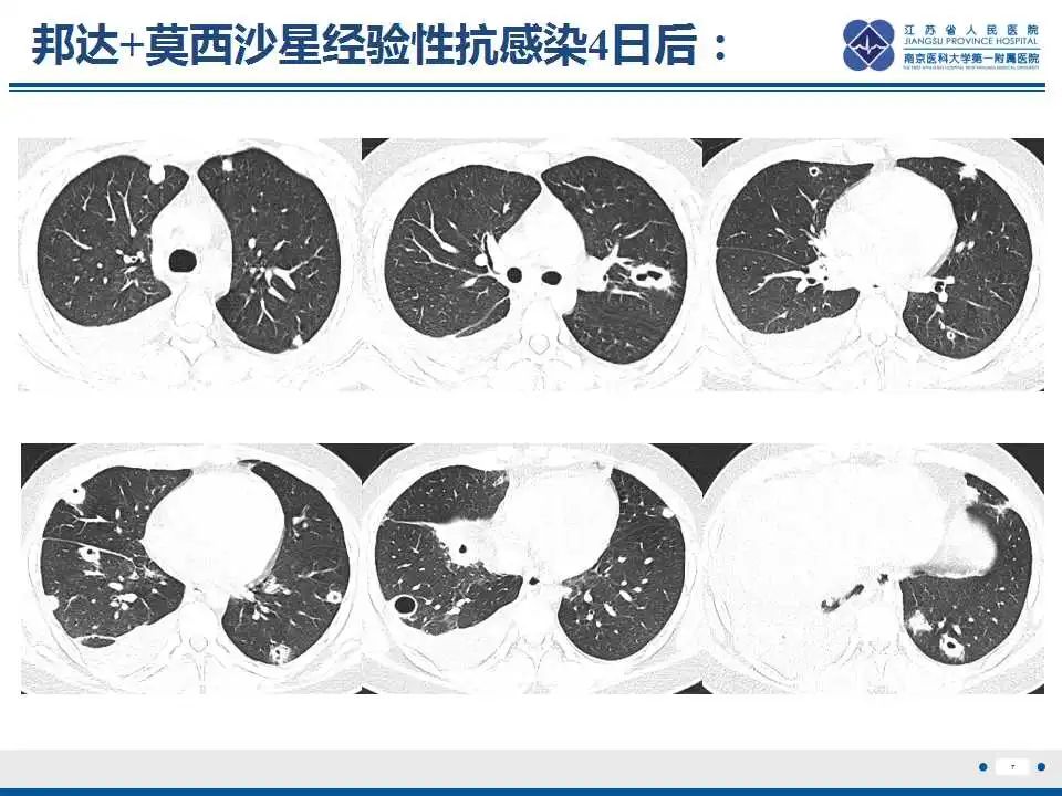 影像PPT - 【PPT】坏死梭杆菌肺炎-8