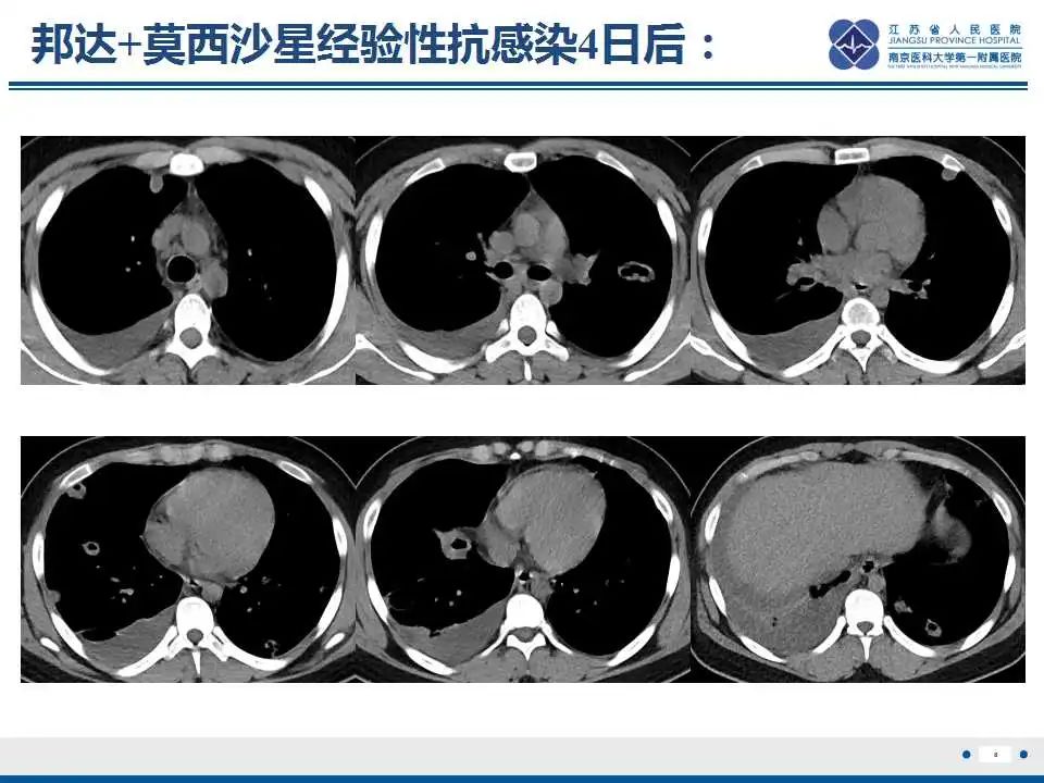 影像PPT - 【PPT】坏死梭杆菌肺炎-9
