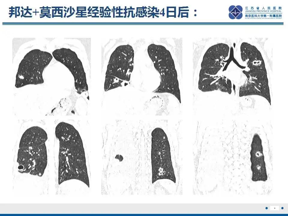 影像PPT - 【PPT】坏死梭杆菌肺炎-10