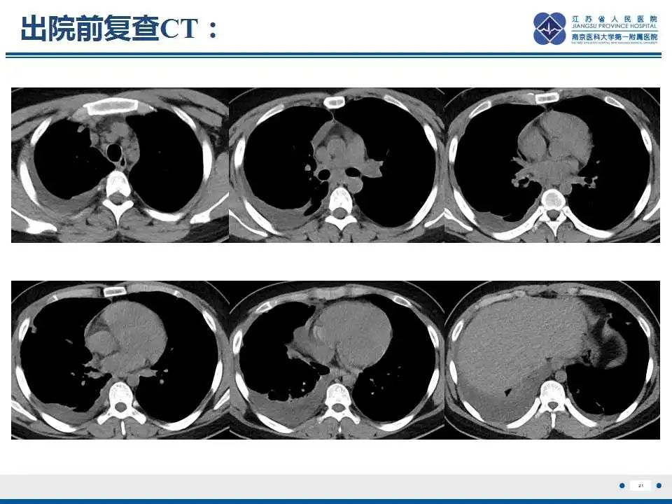 影像PPT - 【PPT】坏死梭杆菌肺炎-22