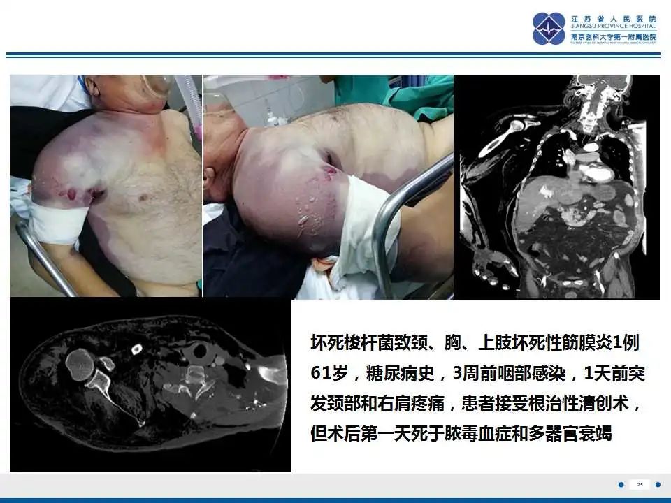影像PPT - 【PPT】坏死梭杆菌肺炎-26