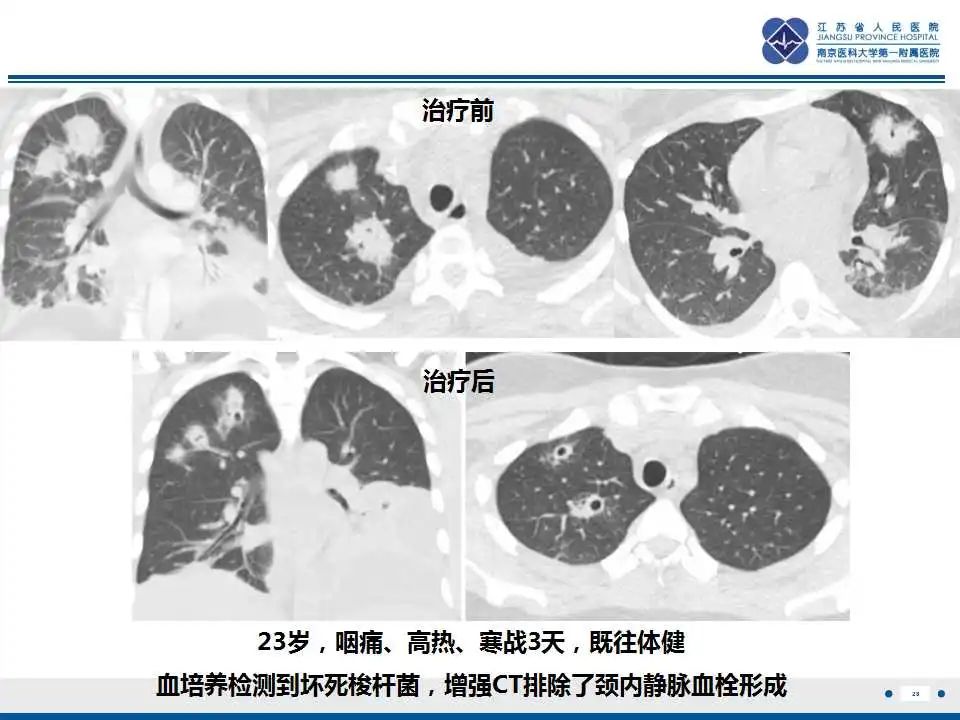影像PPT - 【PPT】坏死梭杆菌肺炎-29