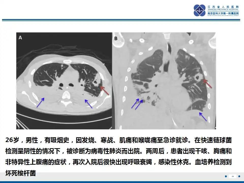 影像PPT - 【PPT】坏死梭杆菌肺炎-30