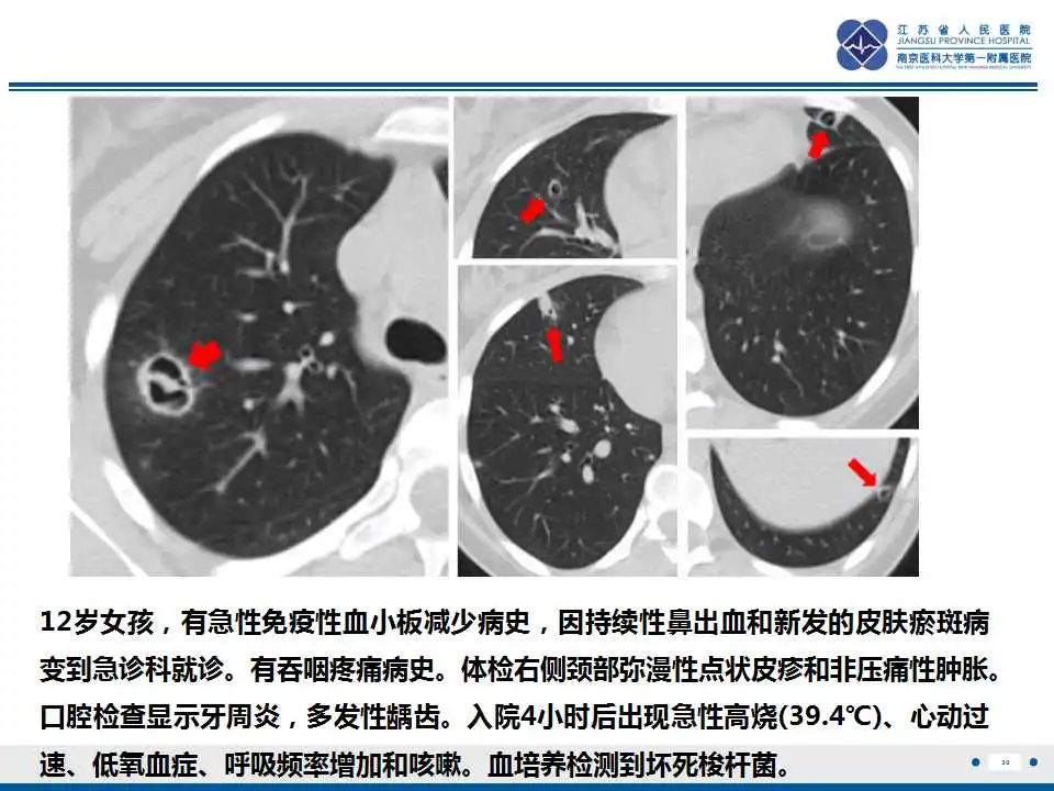影像PPT - 【PPT】坏死梭杆菌肺炎-31