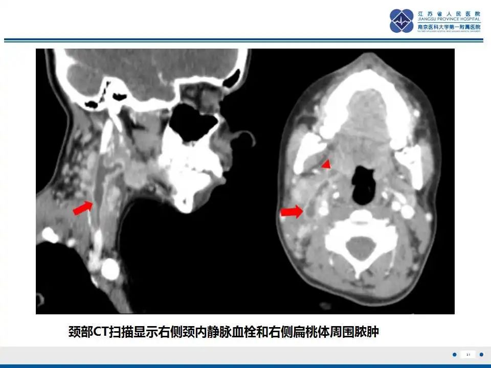 影像PPT - 【PPT】坏死梭杆菌肺炎-32