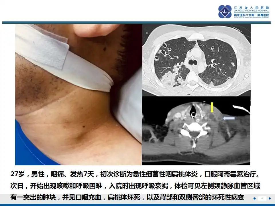影像PPT - 【PPT】坏死梭杆菌肺炎-33