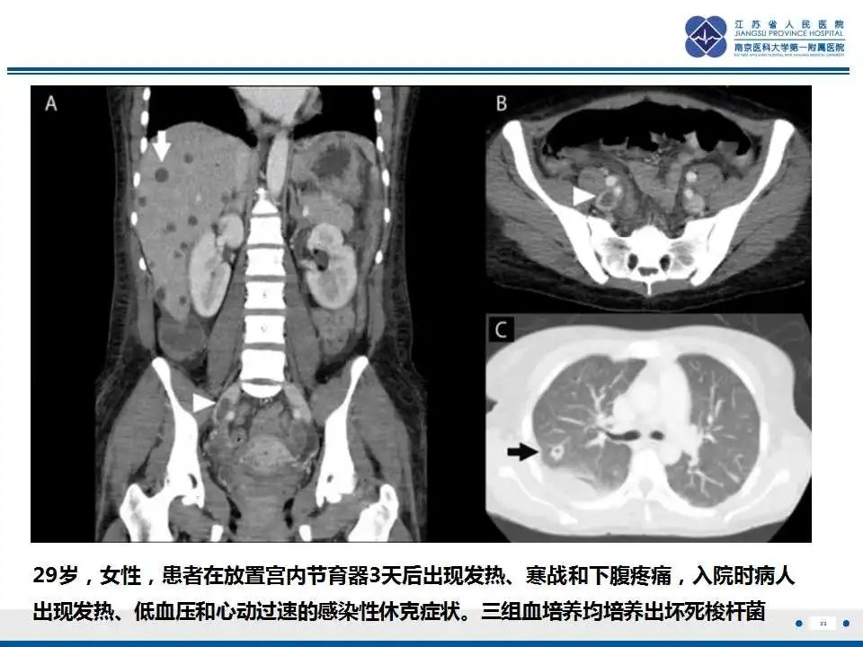 影像PPT - 【PPT】坏死梭杆菌肺炎-34