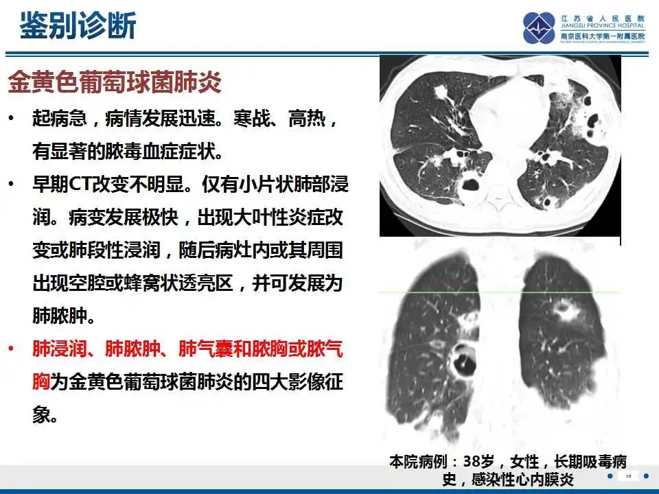 影像PPT - 【PPT】坏死梭杆菌肺炎-36