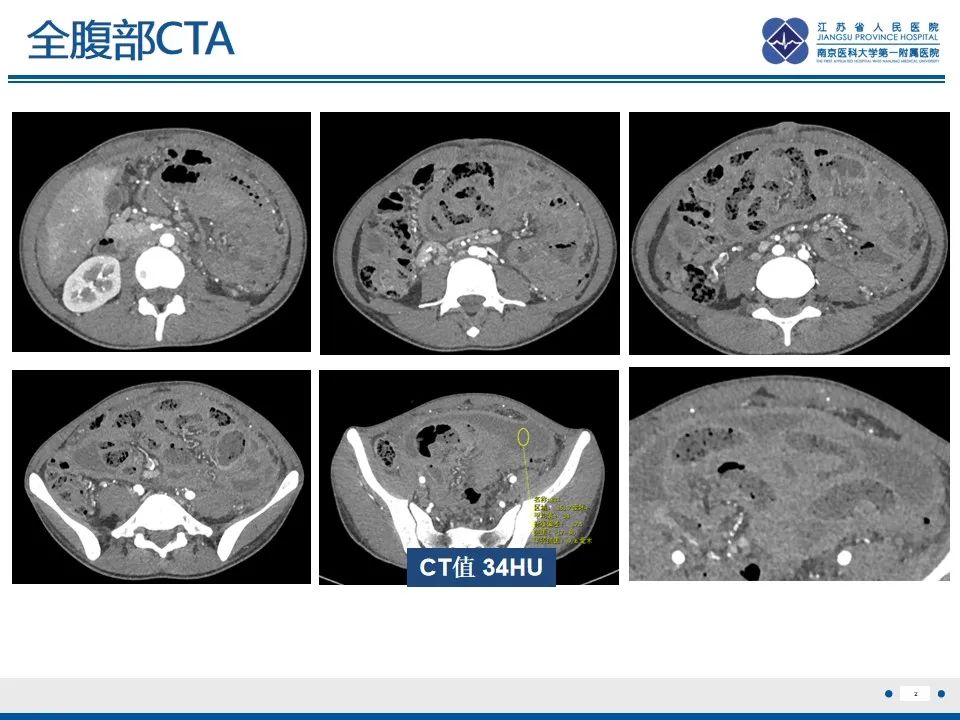 影像PPT - 【PPT】结核性腹膜炎-3