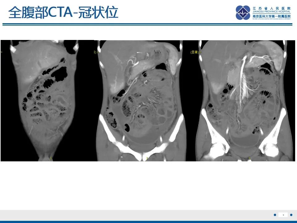 影像PPT - 【PPT】结核性腹膜炎-4