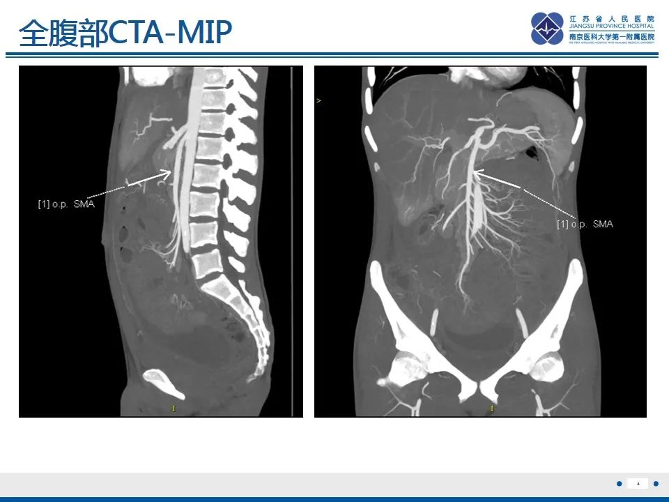 影像PPT - 【PPT】结核性腹膜炎-5