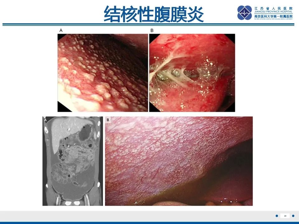 影像PPT - 【PPT】结核性腹膜炎-21