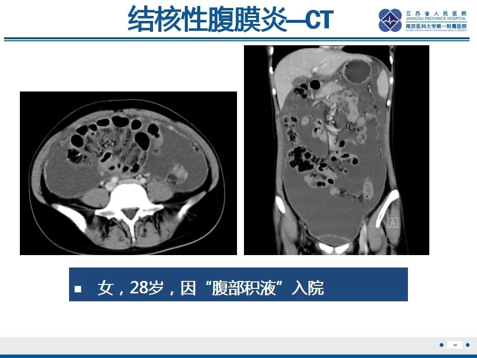影像PPT - 【PPT】结核性腹膜炎-25