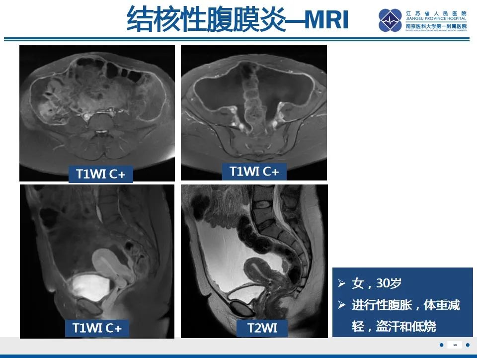 影像PPT - 【PPT】结核性腹膜炎-27