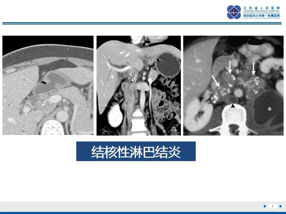 影像PPT - 【PPT】结核性腹膜炎-28