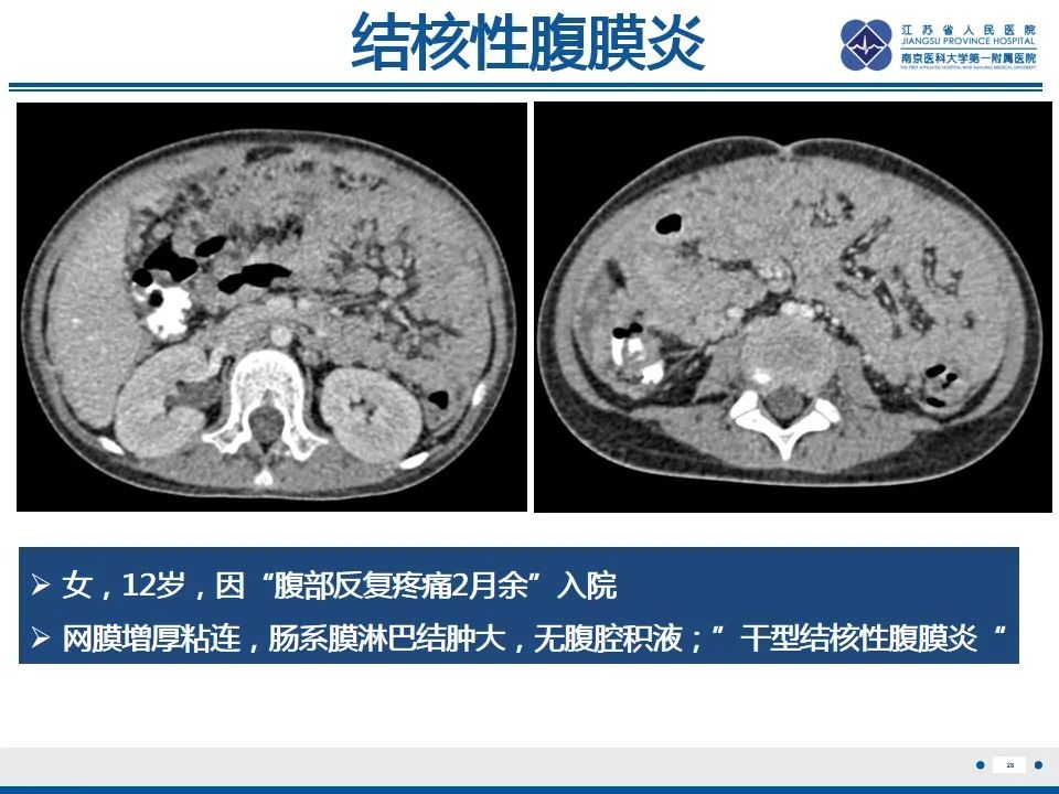 影像PPT - 【PPT】结核性腹膜炎-29