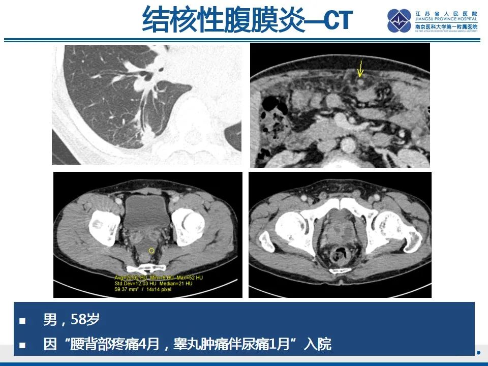 影像PPT - 【PPT】结核性腹膜炎-26