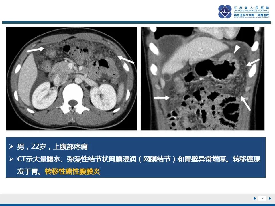 影像PPT - 【PPT】结核性腹膜炎-31