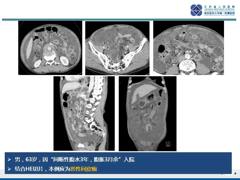 影像PPT - 【PPT】结核性腹膜炎-32