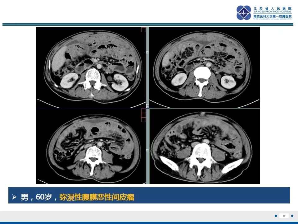 影像PPT - 【PPT】结核性腹膜炎-33